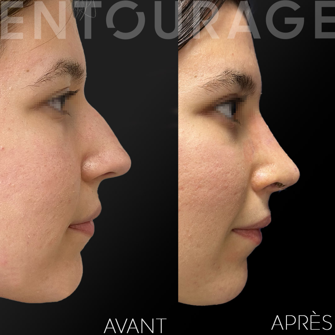 clinique rhinoplastie